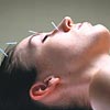 Akupunktur itah azaltyor