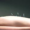 Akupunktur itah azaltarak zayflatr